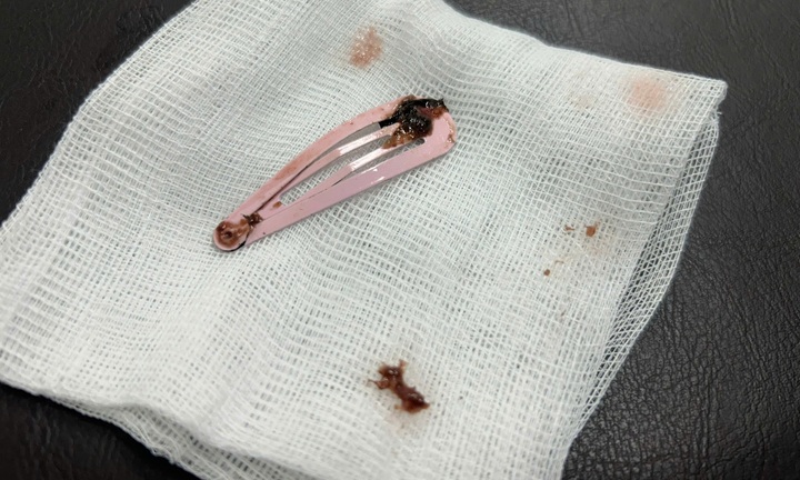 Gắp kẹp tóc dài 7cm khỏi dạ dày bé gái 6 tuổi