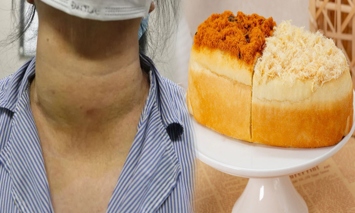 5 thực phẩm người có u tuyến giáp không nên ăn dù thèm đến mấy