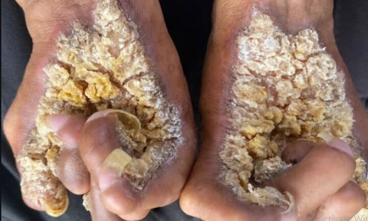 Da xù xì như mọc nấm vì hội chứng lạ