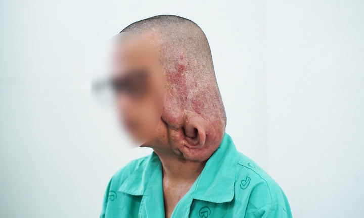 Phẫu thuật cắt bỏ khối u sợi thần kinh gần 1kg gây biến dạng mặt