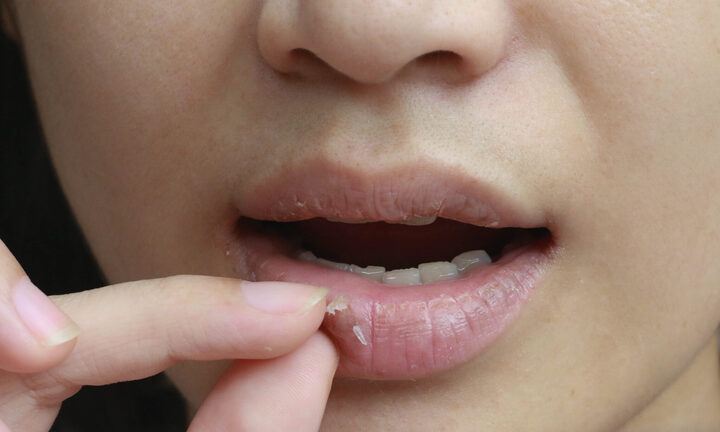 5 dấu hiệu thiếu sắt cần nhận biết sớm, xem ngay để kịp bổ sung