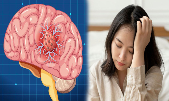 Đau đầu tưởng tiền đình nhưng có thể là 'chỉ điểm' của bệnh trọng