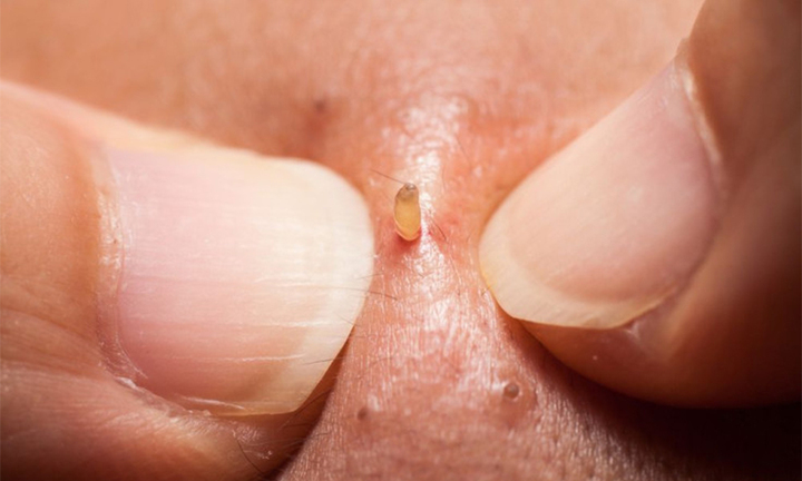 7 lý do nhiều người nghiện xem clip nặn mụn dù trông rất ghê