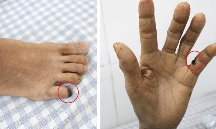 Vết xước do gà đạp khiến người phụ nữ 60 tuổi suýt mất mạng