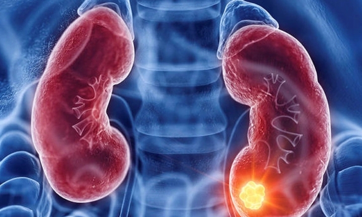Ung thư thận dễ bị bỏ sót, chỉ phát hiện khi trong nước tiểu có máu