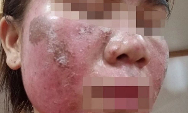 'Vỡ mộng' da đẹp đón Tết: Tan nát mặt vì tự peel da theo hướng dẫn trên mạng