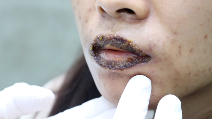 Làm đẹp cấp tốc, nhiều người 'tiền mất tật mang'