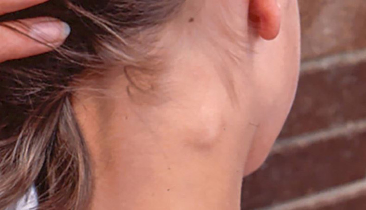 3 bất thường ở cổ cảnh báo ung thư, hãy đi khám bác sĩ ngay lập tức