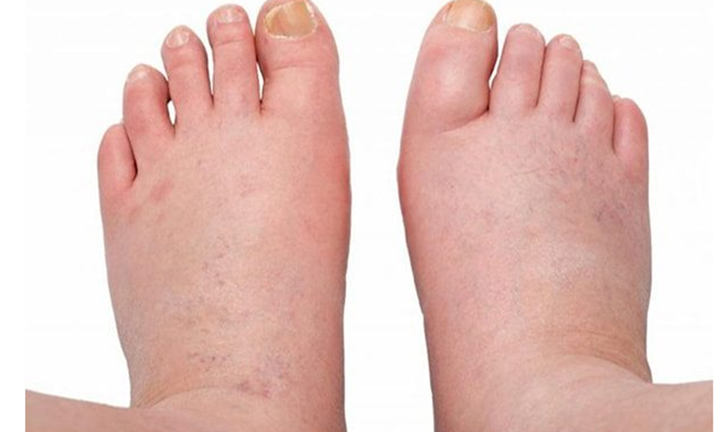 Bàn chân xuất hiện những dấu hiệu này, thận có thể đang 'kêu cứu'