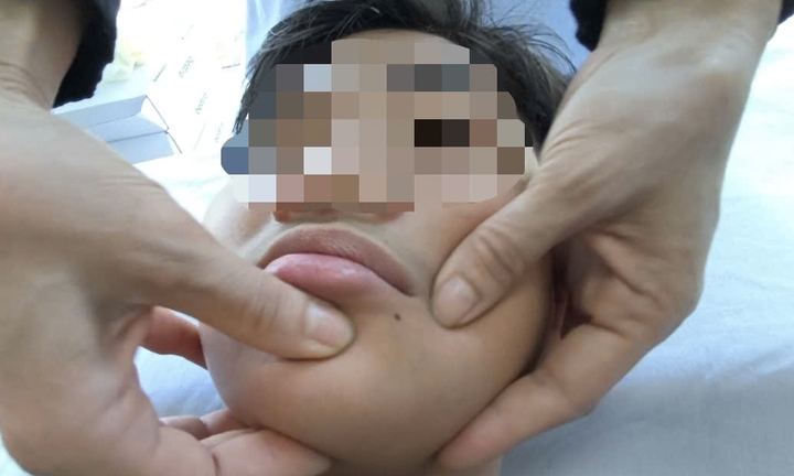 Liệt dây thần kinh số 7 do rét đậm