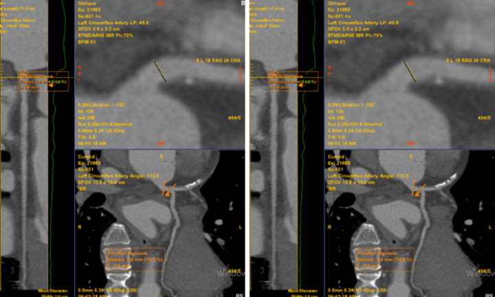 Chỉ đau tức ngực trái thoáng qua, không ngờ phát hiện bệnh lý tim mạch nguy hiểm