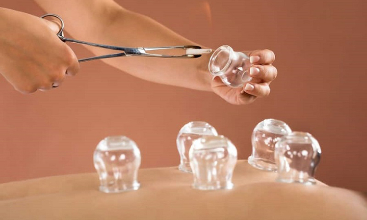 Giác hơi, đánh cảm: Lợi ích khi dùng đúng, hiểm họa khi lạm dụng