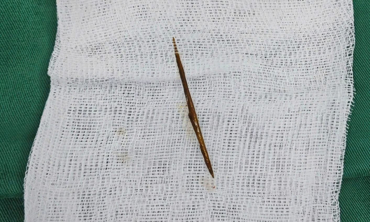 Thủng ruột vì thói quen ngậm tăm sau ăn nhiều người mắc