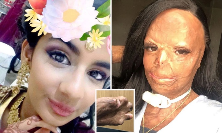 Dầu gội đầu bắt lửa, cô gái bị bỏng nửa người và mất 7 ngón tay