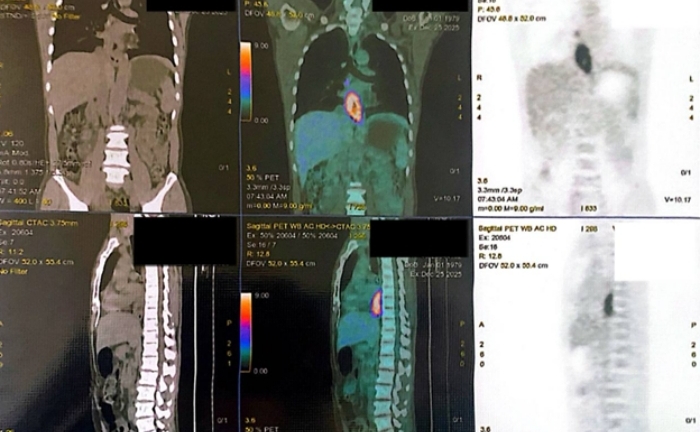 Nuốt nghẹn, sụt 5 kg, đi khám phát hiện mắc hai loại ung thư