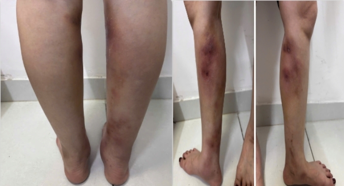 Chân biến dạng sau tiêm filler tại nhà