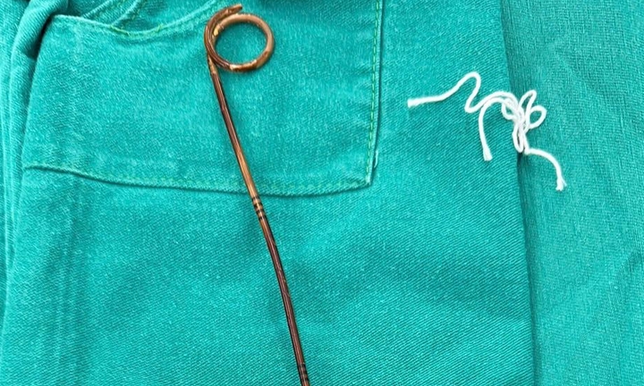 Quên thiết bị y tế trong bụng suốt hai năm