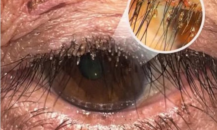 Phát hiện rận mu ký sinh dày đặc trên lông mi người phụ nữ ở Nghệ An