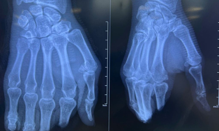  8 giờ vi phẫu nghẹt thở nối lại 4 ngón tay đứt lìa cho người đàn ông