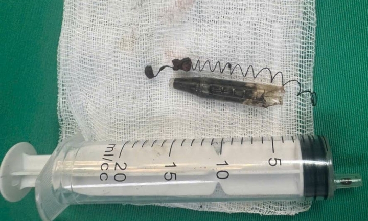 Mang đầu bút bi trong mặt suốt 13 năm không hay biết