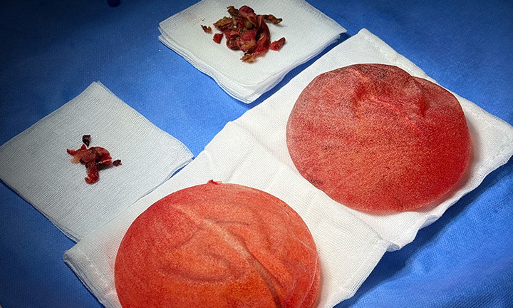 Nguyên nhân gây vỡ túi ngực sớm