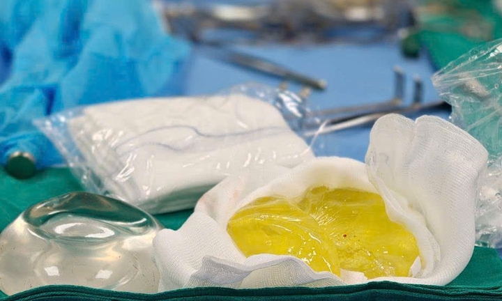 Vỡ túi ngực nhưng không hay biết