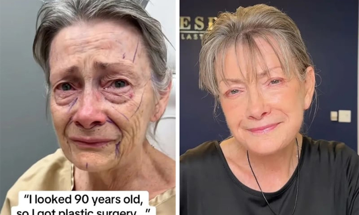 Cụ bà trông như 90 tuổi trẻ hóa kỳ diệu sau phẫu thuật căng da