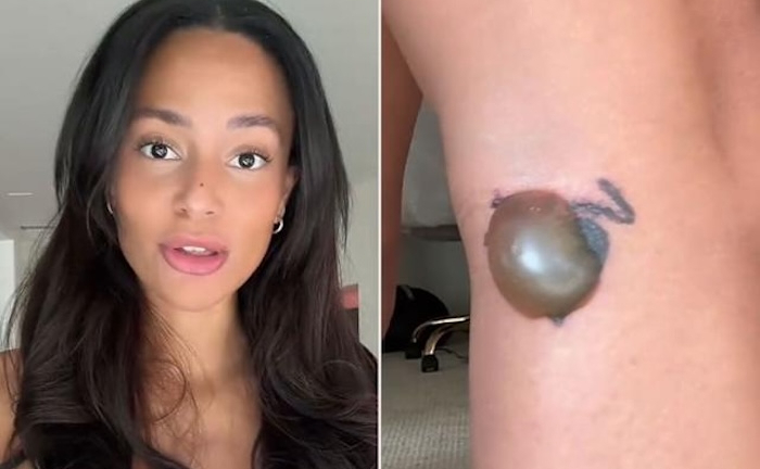 KOL hoảng sợ 'cầu cứu' khi gặp biến chứng 'kinh khủng' sau xóa hình xăm