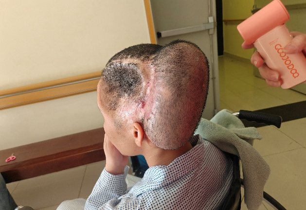 Đột quỵ sau hút mỡ làm đẹp