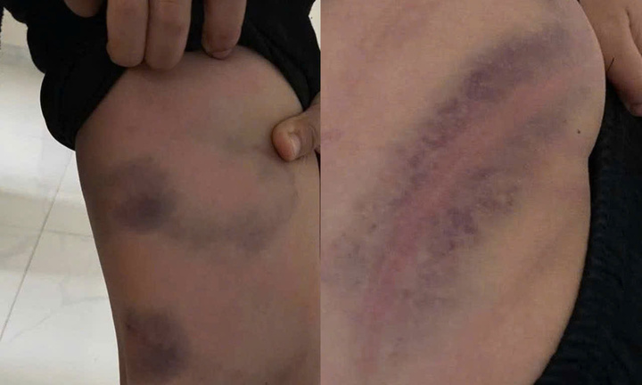 Bé trai ở Bắc Ninh bị cha đánh bầm tím vì lười học