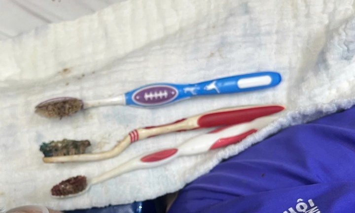 Nuốt liền 3 bàn chải đánh răng, nam thanh niên được cứu kịp thời