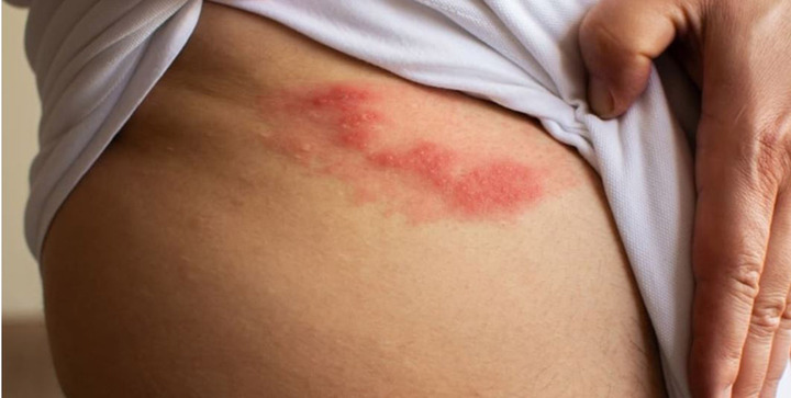 Bị giời leo bôi thuốc gì cho nhanh khỏi?