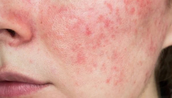 Hiểm họa khi tự ý lạm dụng thuốc, mỹ phẩm chứa corticoid