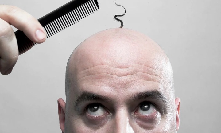 Quốc gia nào có nhiều người hói nhất thế giới?