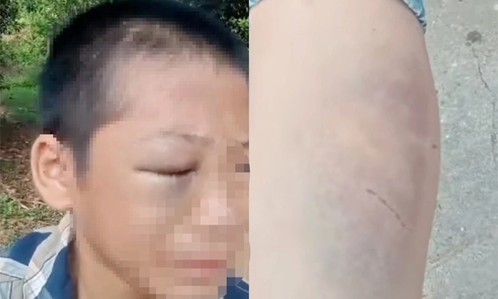 Cháu bé 12 tuổi nghi bị bố, mẹ kế đánh bầm tím khắp người: Thông tin mới nhất