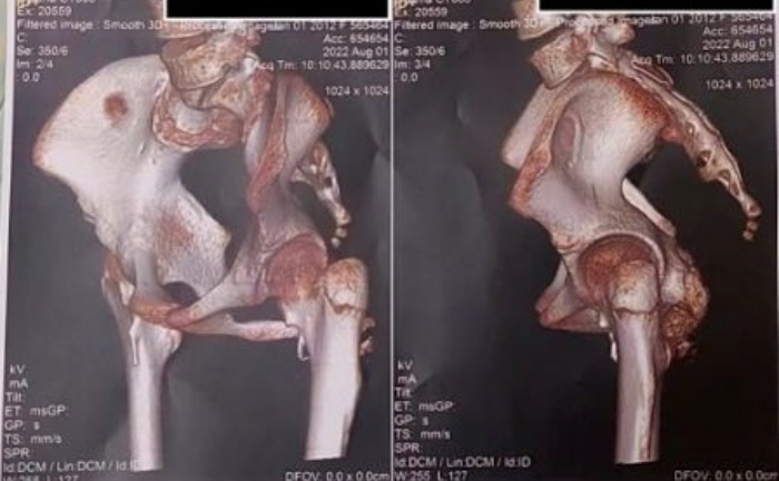 Lần theo dấu vết bất thường, bác sĩ phát hiện bệnh 'người hóa đá' hiếm gặp