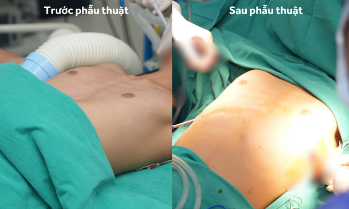 Vinmec Hải Phòng 'hồi sinh' lồng ngực bị lõm cho cậu bé 13 tuổi