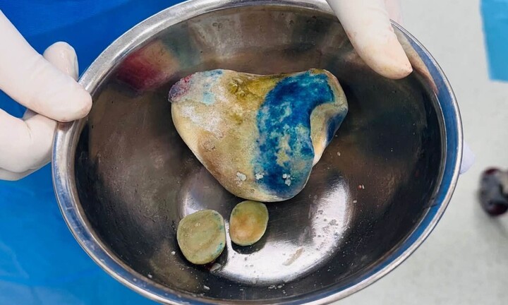 Cụ ông 86 tuổi mang khối sỏi bàng quang gần nửa kg