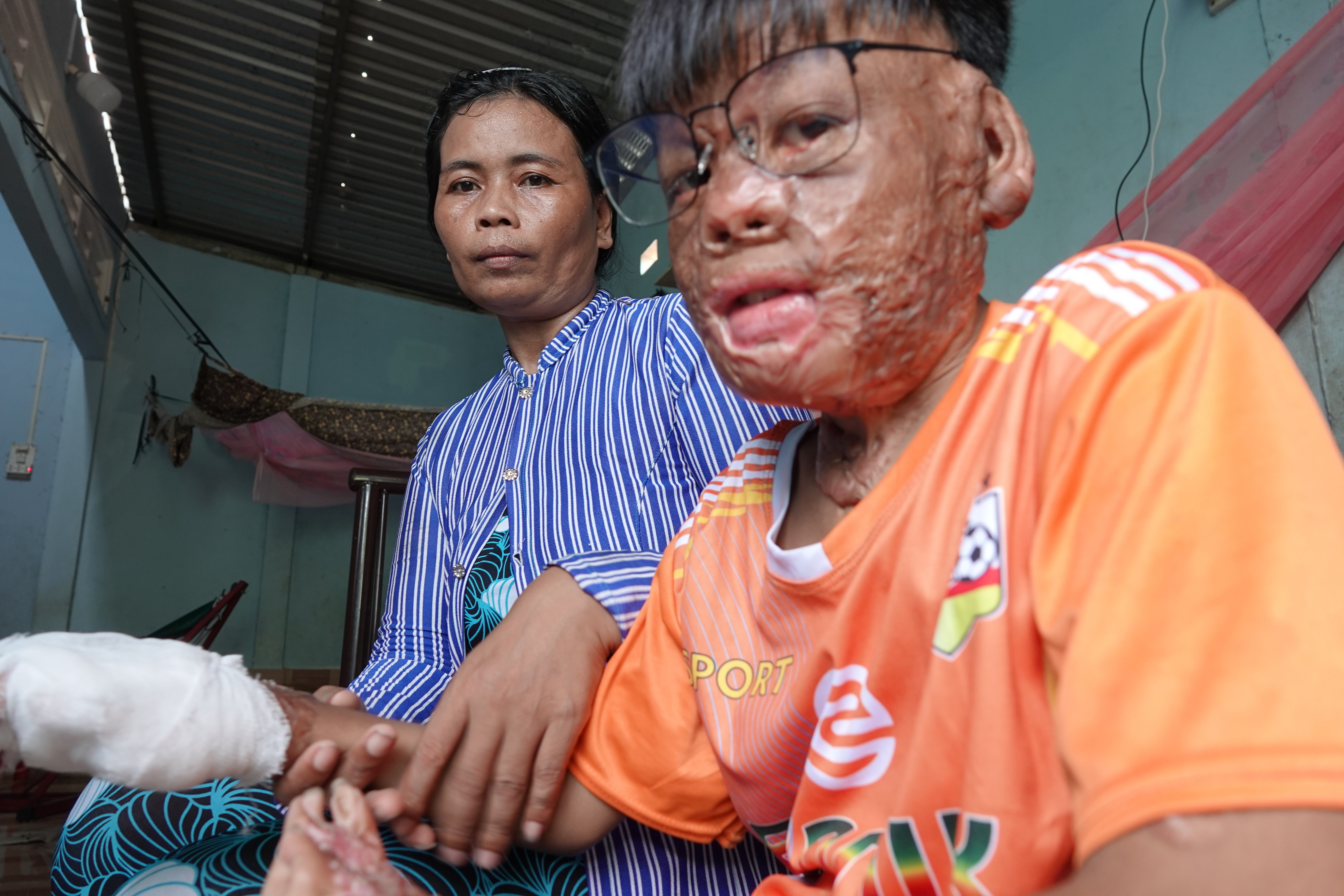 Cậu bé liều mình cứu mẹ nuôi lúc nổ bình gas: 2 năm, 20 cuộc phẫu thuật đau đớn - 2