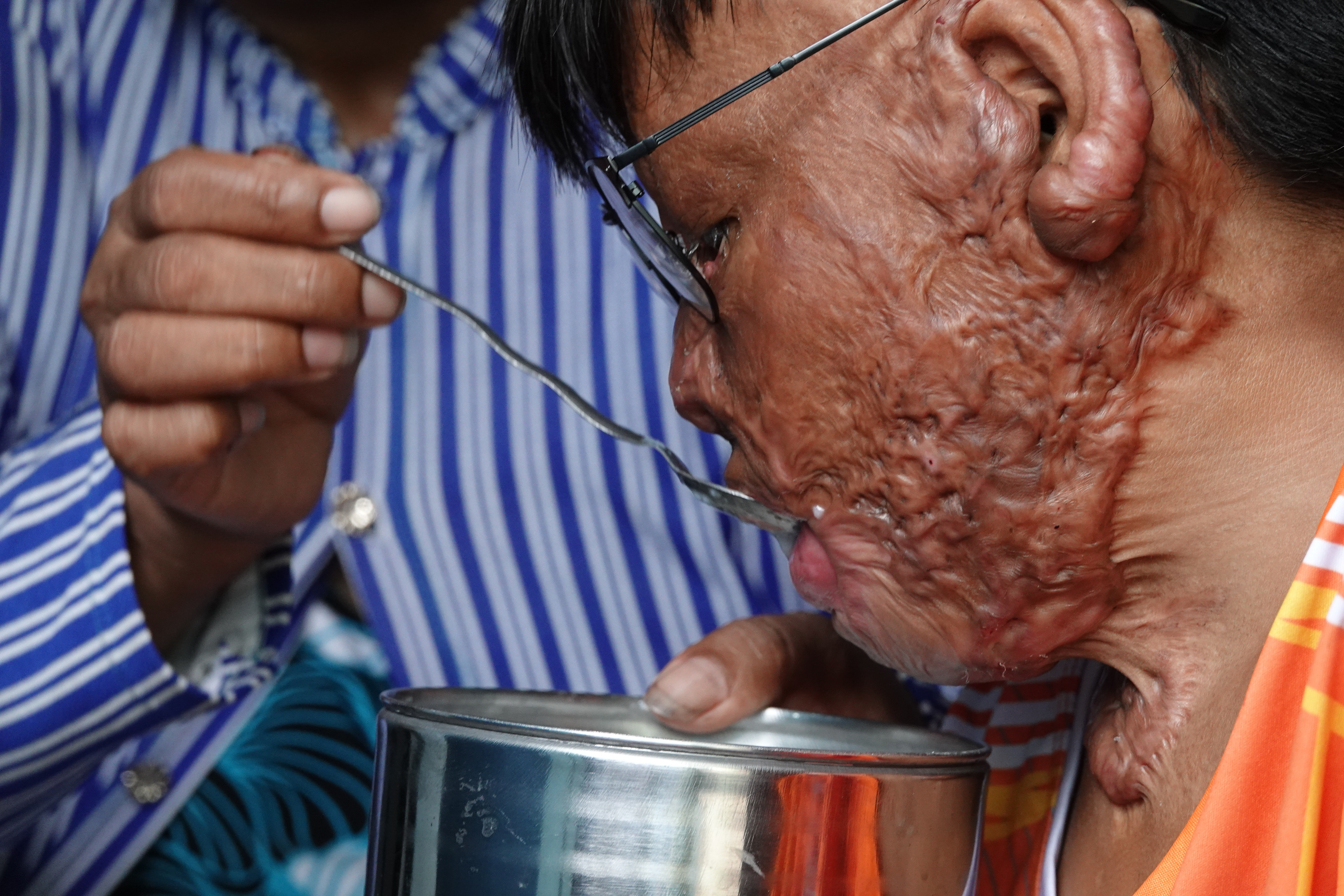 Cậu bé liều mình cứu mẹ nuôi lúc nổ bình gas: 2 năm, 20 cuộc phẫu thuật đau đớn - 3