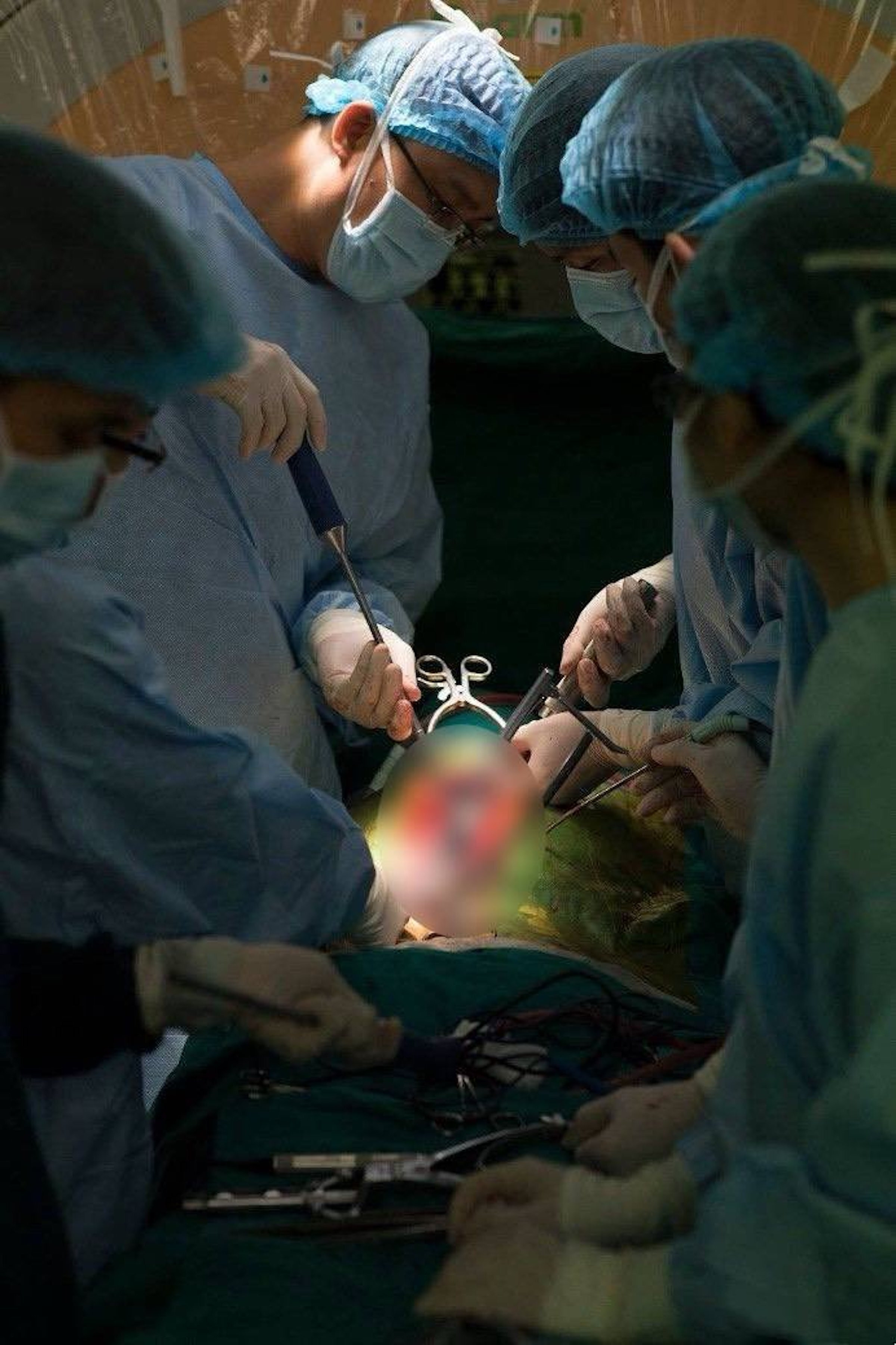 Bác sỹ trắng đêm chỉnh cột sống hình con rắn cho bé gái 13 tuổi - 9