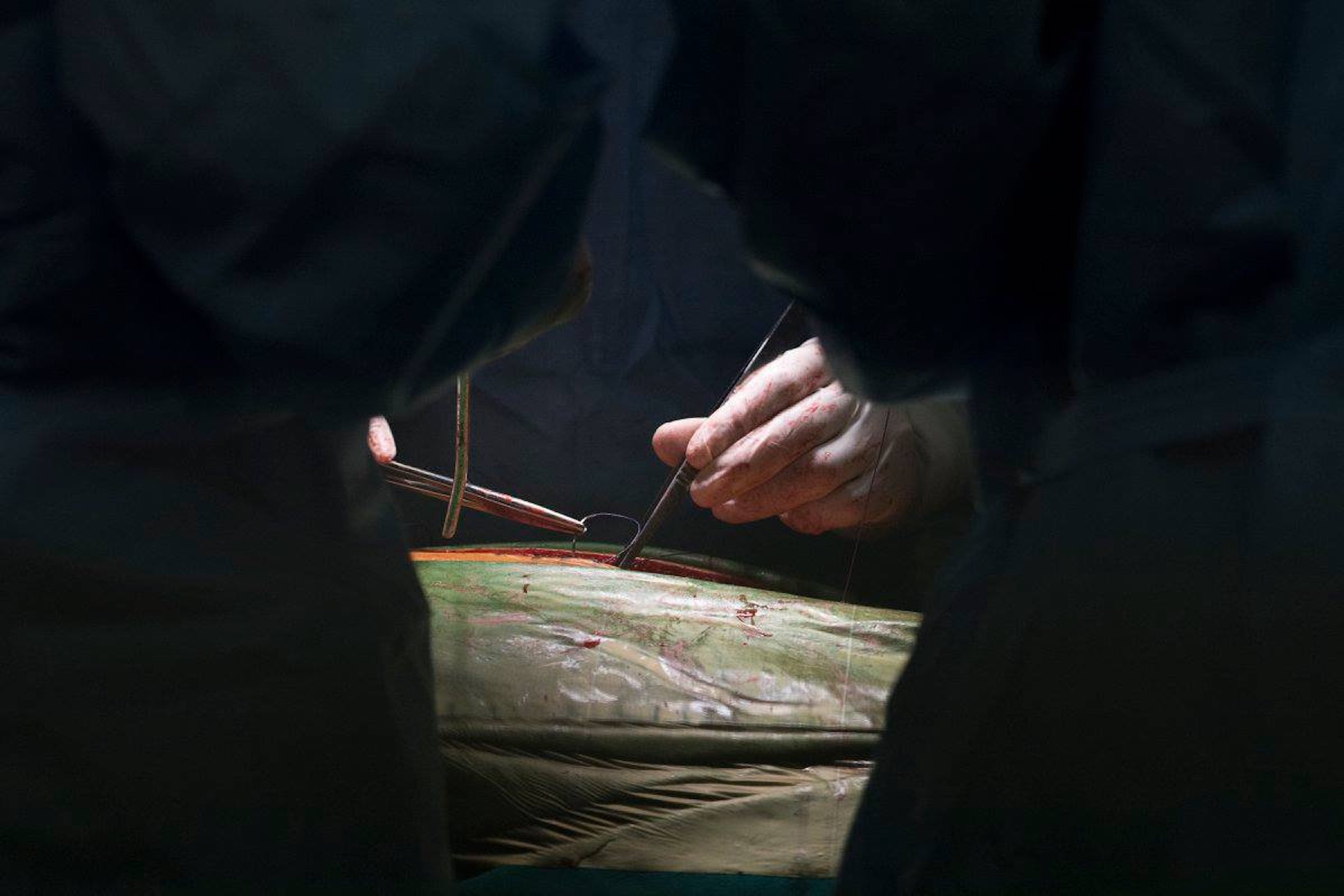 Bác sỹ trắng đêm chỉnh cột sống hình con rắn cho bé gái 13 tuổi - 15