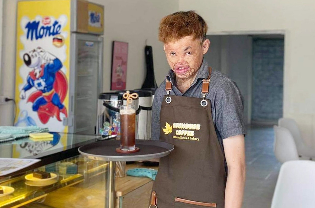 Bị bỏng biến dạng cơ thể, chàng trai hồi sinh sau 20 lần phẫu thuật - 2