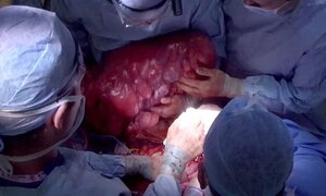 Cụ bà 74 tuổi mang khối u 19kg nhiều năm trong bụng