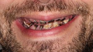 Nghiện nước ngọt có ga, phải nhổ hết 27 chiếc răng sâu