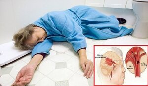 Nữ bệnh nhân đột quỵ, chảy máu não được cứu sống bất ngờ