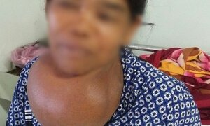Khối u bướu giáp khổng lồ 35 năm trên cổ bệnh nhân