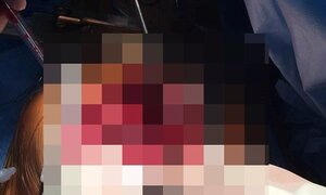 Nam sinh viên mắc khối u hiếm gặp chèn ép tim cực kỳ nguy hiểm