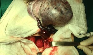 Tưởng đau bụng bình thường, đi khám phát hiện u nang buồng trứng 'khổng lồ' có dấu hiệu hoại tử