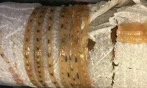 Tin là 'thần dược' nuốt ếch sống chữa bệnh, người phụ nữ bị sán ký sinh trong bầu vú